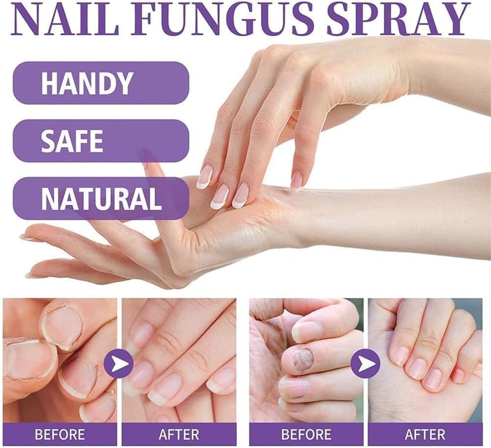 Nail Fungal Spray, Fungal Nail Treatment, Advanced Foot and Nail Spray, Toenail Fungus Treatment, Toenail Fungus Treatment and Nail Strengthener, Restore Healthy Nails (100ml)"