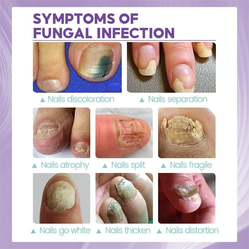 Nail Fungal Spray, Fungal Nail Treatment, Advanced Foot and Nail Spray, Toenail Fungus Treatment, Toenail Fungus Treatment and Nail Strengthener, Restore Healthy Nails (100ml)"